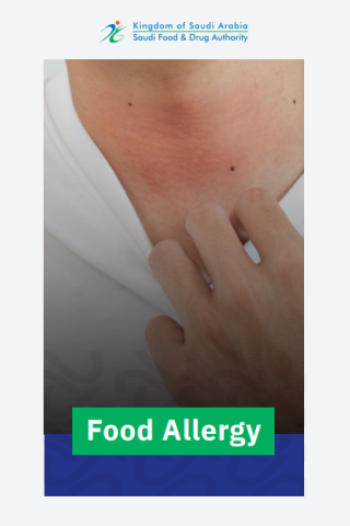 food allergy